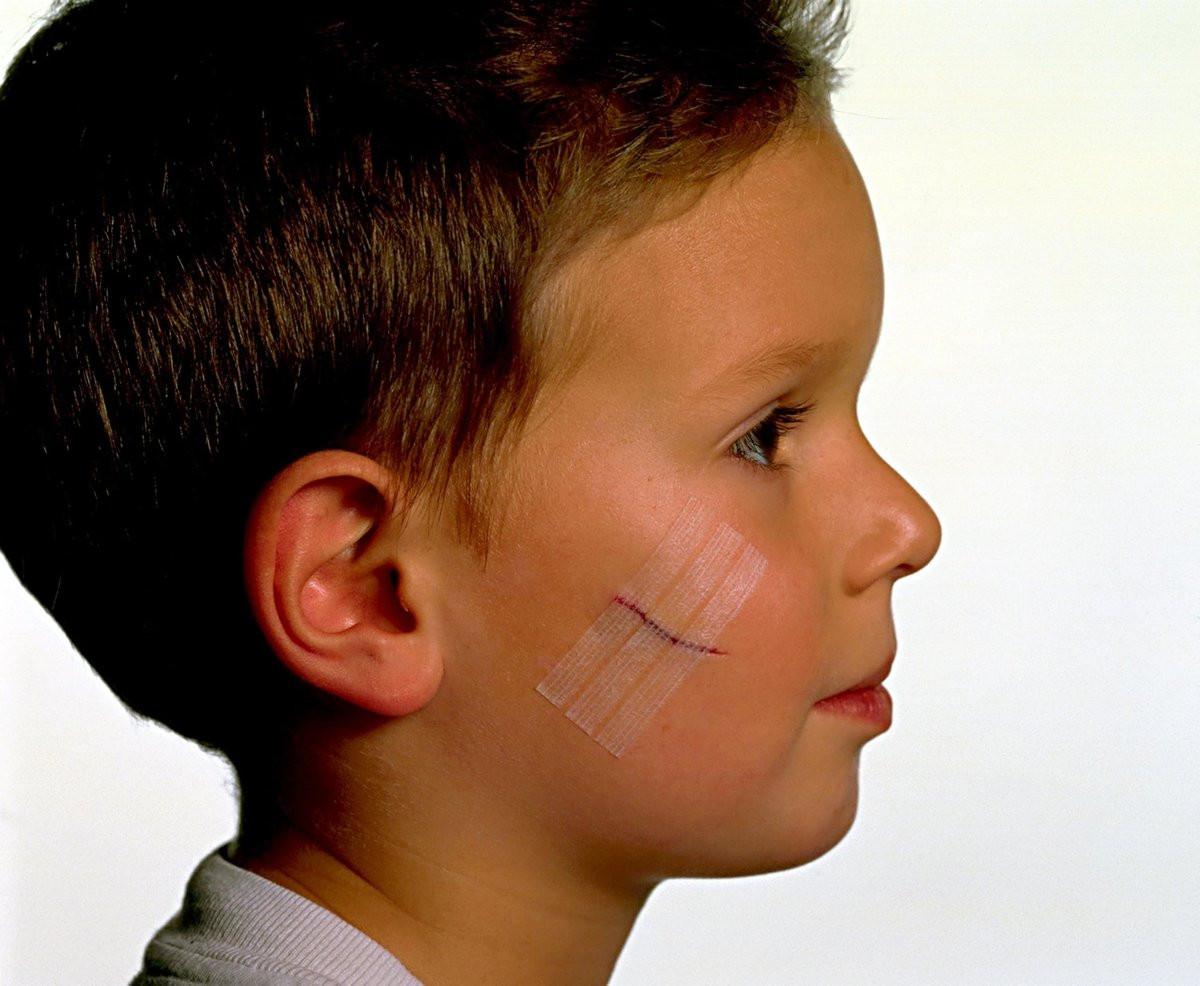 Nexcare Steri-Strip Wundverschluss, atmungsaktive Streifen für kleinen Wunden, ideal nach Nähten oder Klammern - 30 Wundverschlüsse