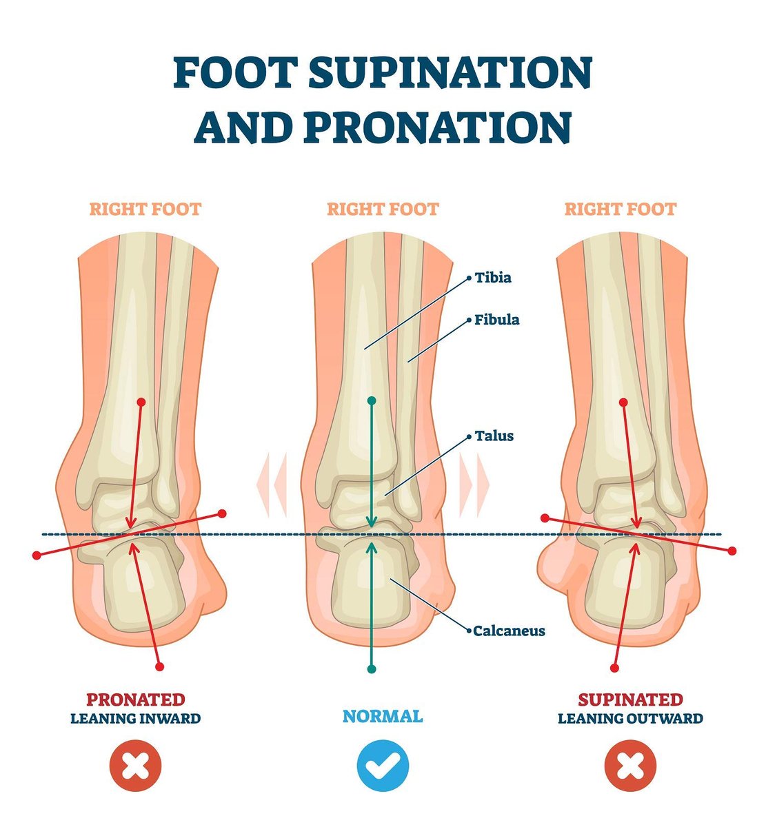 pedag Correct Fersenkeil | Medialer & Lateraler Keil für Pronation & Supination | Knickfuß & O-Bein Schmerzen | Hergestellt in Deutschland | Extra Large (Herren 11L bis 13)