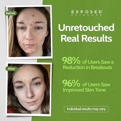 Exposed Skin Care Clear Pore Serum mit 1% Salicylsäure für empfindliche und fettige Haut – Sanfte Reinigung von Mitessern, Verkleinerung der Poren und Reduzierung von überschüssigem Öl – natürlich, ungiftig und tierversuchsfrei