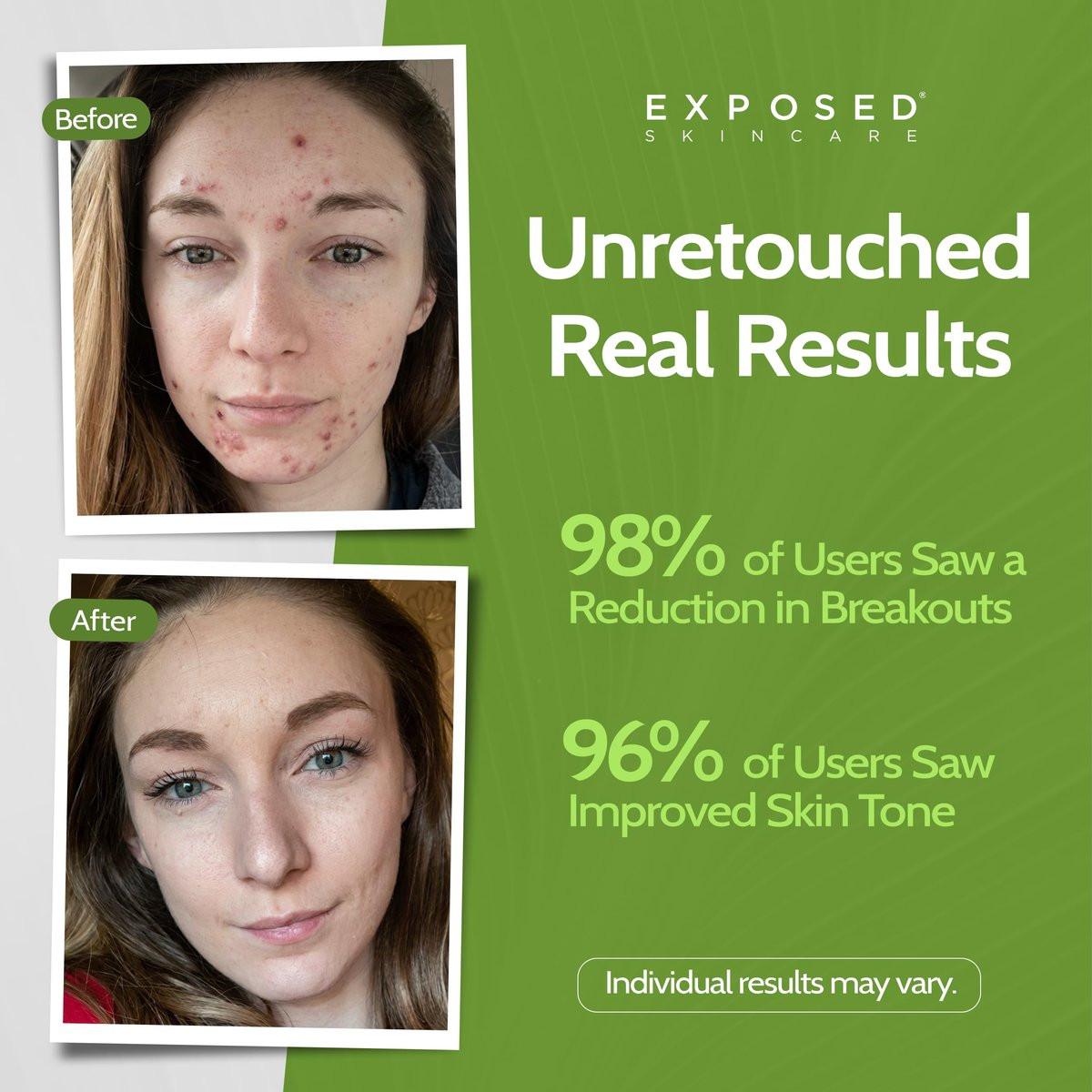 Exposed Skin Care Clear Pore Serum mit 1% Salicylsäure für empfindliche und fettige Haut – Sanfte Reinigung von Mitessern, Verkleinerung der Poren und Reduzierung von überschüssigem Öl – natürlich, ungiftig und tierversuchsfrei