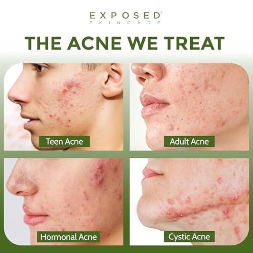 Exposed Skin Care Clear Pore Serum mit 1% Salicylsäure für empfindliche und fettige Haut – Sanfte Reinigung von Mitessern, Verkleinerung der Poren und Reduzierung von überschüssigem Öl – natürlich, ungiftig und tierversuchsfrei