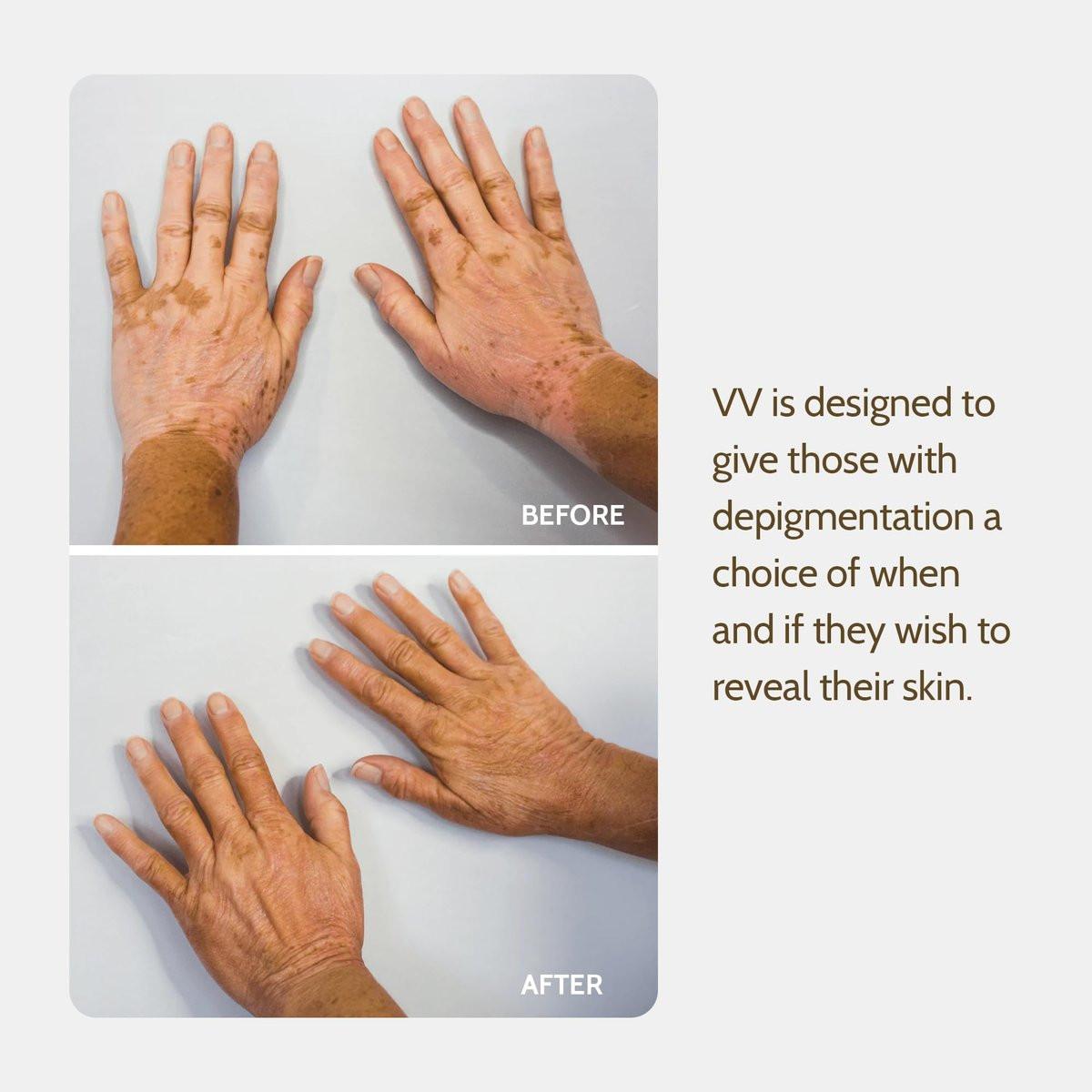 Fake Bake Vitiligo Vanquish Kosmetik-Camouflage-Kit – Langanhaltende flüssige Concealer für natürliche Farbanpassung, kaschiert Hautdepigmentierung für Frauen & Männer – Abdeckung hält tagelang