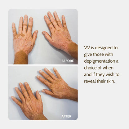 Fake Bake Vitiligo Vanquish Kosmetik-Camouflage-Kit – Langanhaltende flüssige Concealer für natürliche Farbanpassung, kaschiert Hautdepigmentierung für Frauen & Männer – Abdeckung hält tagelang