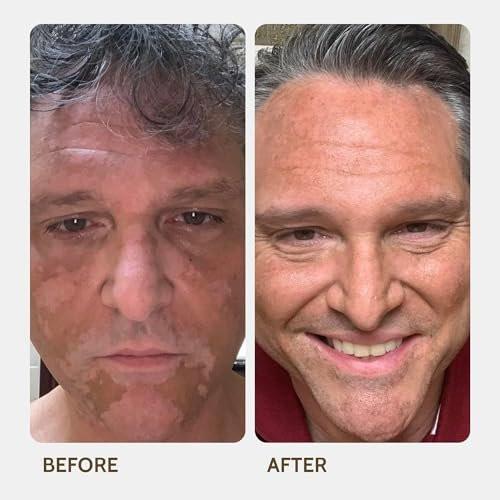 Fake Bake Vitiligo Vanquish Kosmetik-Camouflage-Kit – Langanhaltende flüssige Concealer für natürliche Farbanpassung, kaschiert Hautdepigmentierung für Frauen & Männer – Abdeckung hält tagelang