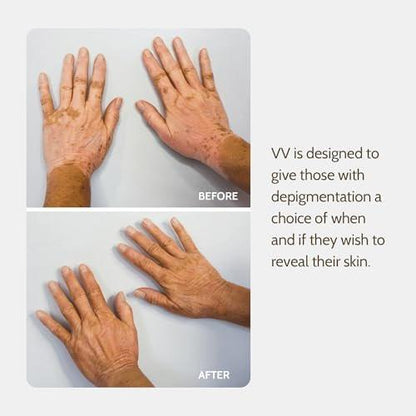 Fake Bake Vitiligo Vanquish Kosmetik-Camouflage-Kit – Langanhaltende flüssige Concealer für natürliche Farbanpassung, kaschiert Hautdepigmentierung für Frauen & Männer – Abdeckung hält tagelang