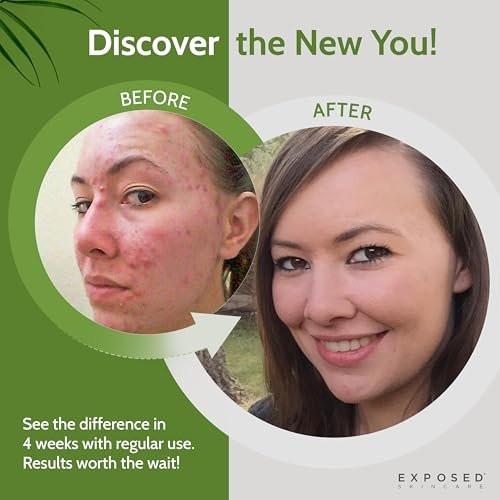 Exposed Skin Care Klärendes Gesichtswasser mit 1% Salicylsäure und Hamamelis – Tägliches Toner für Teenager und Erwachsene mit Akne, Mitessern und fettiger Haut – Natürlich, ungiftig und tierversuchsfrei