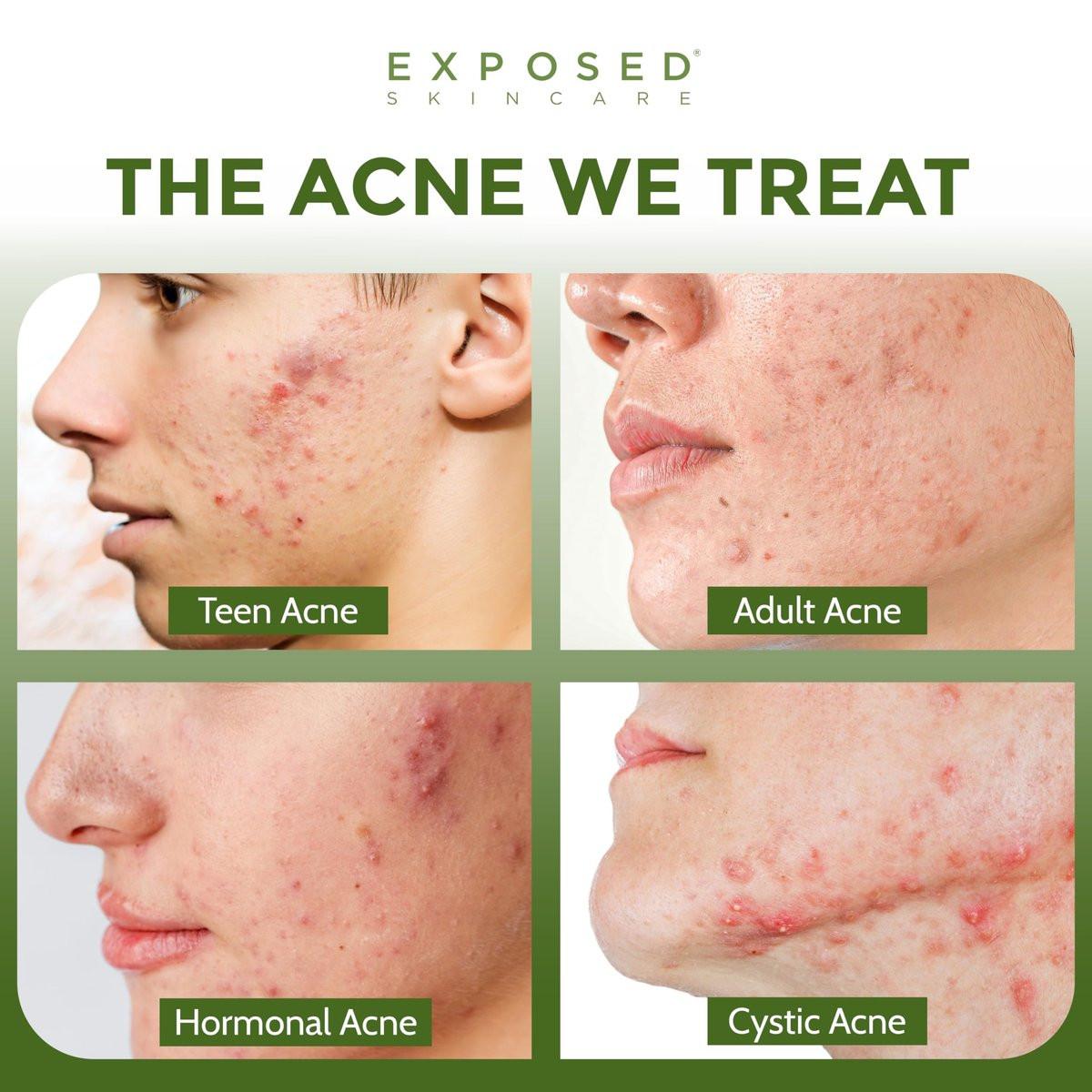 Exposed Skin Care Klärendes Gesichtswasser mit 1% Salicylsäure und Hamamelis – Tägliches Toner für Teenager und Erwachsene mit Akne, Mitessern und fettiger Haut – Natürlich, ungiftig und tierversuchsfrei