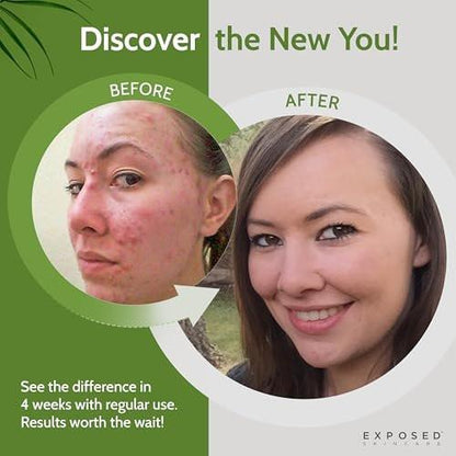Exposed Skin Care Klärendes Gesichtswasser mit 1% Salicylsäure und Hamamelis – Tägliches Toner für Teenager und Erwachsene mit Akne, Mitessern und fettiger Haut – Natürlich, ungiftig und tierversuchsfrei