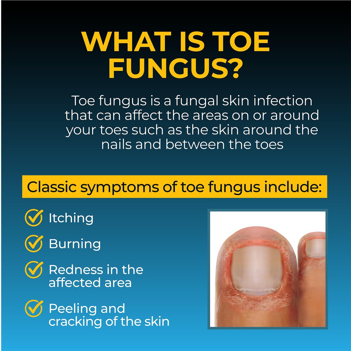 Fungi Nail Anti-Fungale Salbe 0,7 Fl Oz – Tötet Pilze, die zu Fußpilz führen können, mit Tolnaftat – Zehennagelpilzbehandlung – klinisch erwiesen zur Heilung von Infektionen – natürliche Farbe