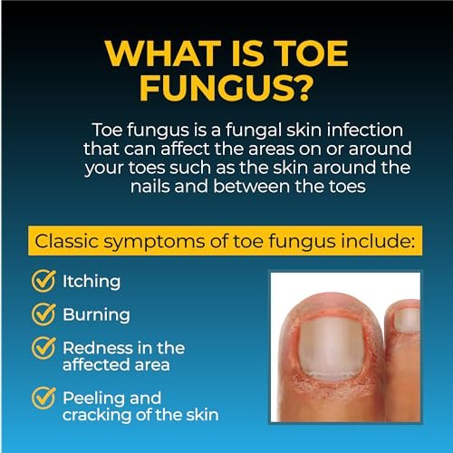 Fungi Nail Anti-Fungale Salbe 0,7 Fl Oz – Tötet Pilze, die zu Fußpilz führen können, mit Tolnaftat – Zehennagelpilzbehandlung – klinisch erwiesen zur Heilung von Infektionen – natürliche Farbe