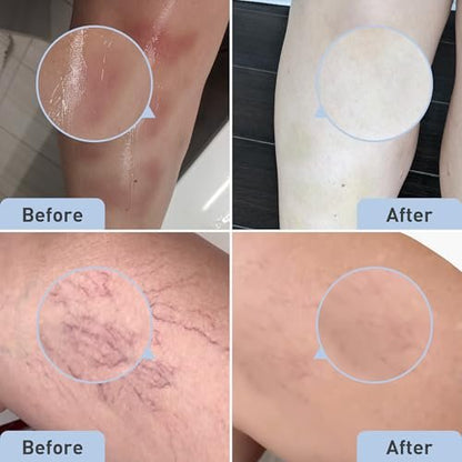 PROcure Prell-Gel gegen Blutergüsse – Arnika Montana & MSM zur Reduzierung von Blutergüssen, Besenreisern & Hautverfärbungen an Füßen & Knöcheln