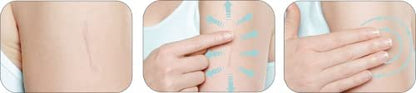 Mederma Hautpflege – Reduziert Narben von Operationen, Verletzungen, Verbrennungen, Akne und Dehnungsstreifen