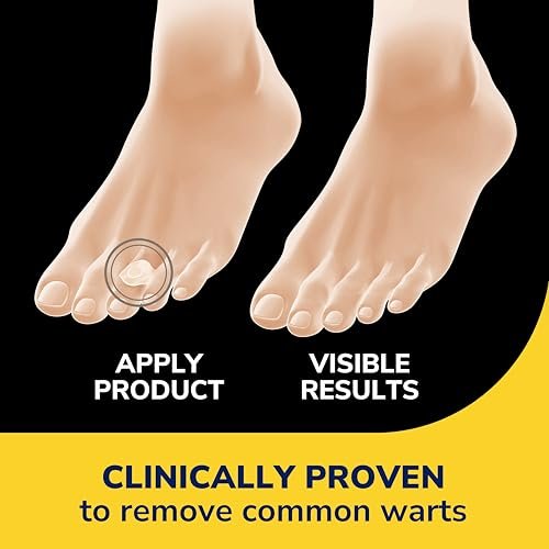 Dr. Scholl's Clear Away Warzenentferner Hydrogel-Bandagen für Finger und Zehen – Klinisch erwiesen wirksame Warzenentfernung und polsternde Schmerzlinderung, bequeme mehrteilige Pflaster