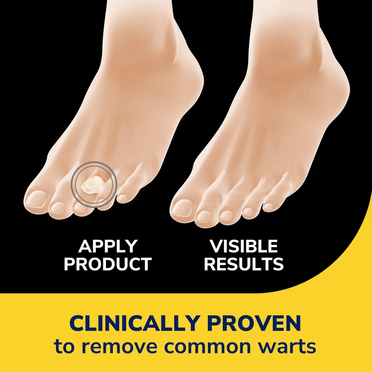 Dr. Scholl's Clear Away Warzenentferner Hydrogel-Bandagen für Finger und Zehen – Klinisch erwiesen wirksame Warzenentfernung und polsternde Schmerzlinderung, bequeme mehrteilige Pflaster