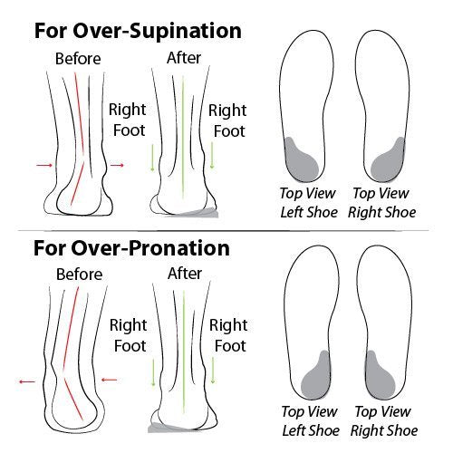 Fersenkeil für Überpronation und Übersupination – Wiederverwendbare selbstklebende Gel-Einlage