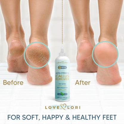 LOVE, LORI Hornhautentferner für die Füße (Extra Stärke) – Fuß-Hornhautentferner-Gel – Pediküre-Werkzeug für Fußpeeling – Fußpflege-Spa-Essentials, 177 ml