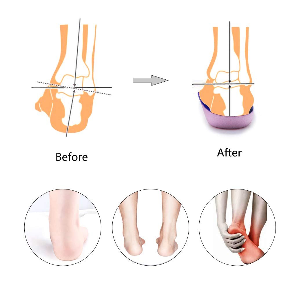 PCSsole 3/4 Ortho-Einlegesohlen mit hohem Fußgewölbe für Plantarfasziitis, Plattfüße, Überpronation und Fersensporn – Schmerzlinderung (Lila, Herren 6,5-8,5 / Damen 7,5-9,5)
