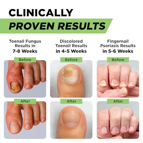 Footcure Antimykotischer Nagelstift – Extra starke Nagelpilzbehandlung mit 25 % Undecylensäure, Teebaum- & Oreganoöl, hergestellt in den USA