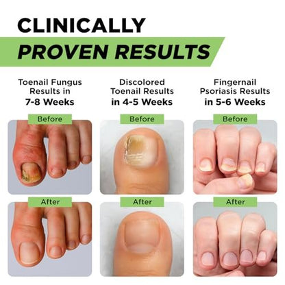 Footcure Antimykotischer Nagelstift – Extra starke Nagelpilzbehandlung mit 25 % Undecylensäure, Teebaum- & Oreganoöl, hergestellt in den USA