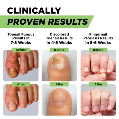 Footcure Antimykotischer Nagelstift – Extra starke Nagelpilzbehandlung mit 25 % Undecylensäure, Teebaum- & Oreganoöl, hergestellt in den USA