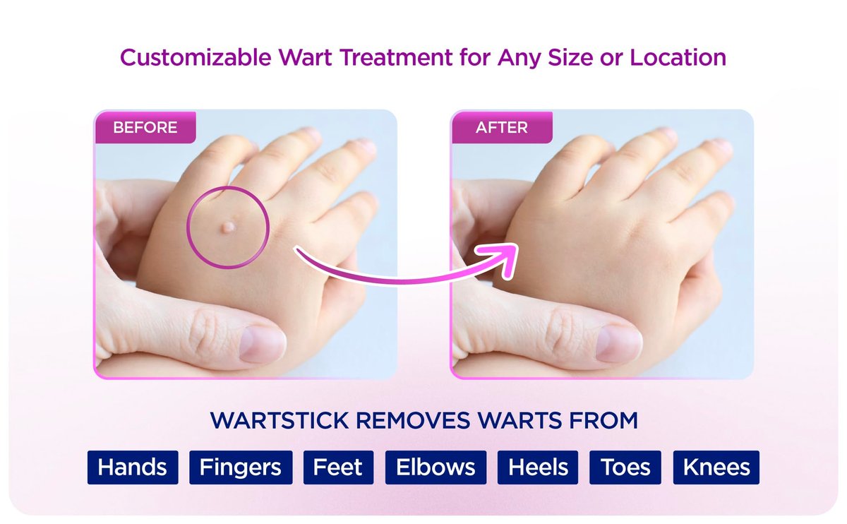 WartStick Maximum Strength Salicylsäure Feststift Warzenentferner für gewöhnliche und plantare Warzen, 2er Pack, 11,3 g