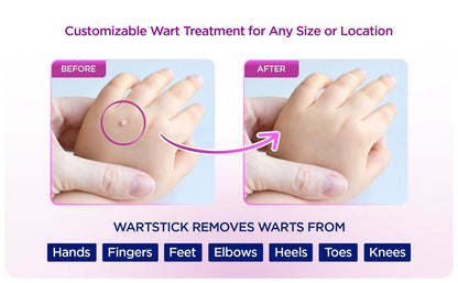 WartStick Maximum Strength Salicylsäure Feststift Warzenentferner für gewöhnliche und plantare Warzen, 2er Pack, 11,3 g