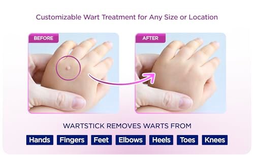 WartStick Maximum Strength Salicylsäure Feststift Warzenentferner für gewöhnliche und plantare Warzen, 2er Pack, 11,3 g
