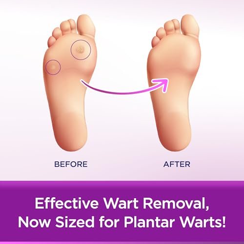 WartStick Plantar Maximalstärke Warzenentferner mit Salicylsäure, Stift für Plantarwarzen, 0,34 Unzen