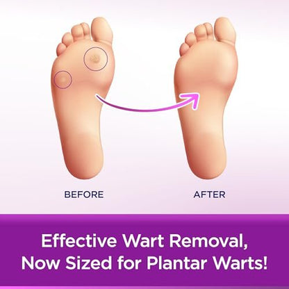 WartStick Plantar Maximalstärke Warzenentferner mit Salicylsäure, Stift für Plantarwarzen, 0,34 Unzen