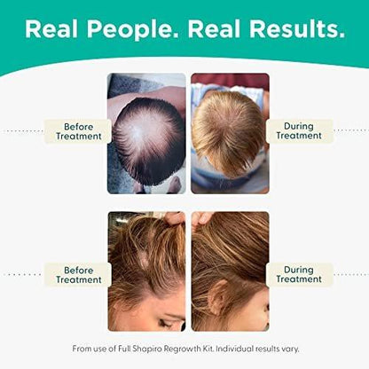 Shapiro MD Haarausfall Experten Leave-in Conditioner – DHT-blockierende vegane Formel für dünner werdendes Haar, entwickelt von Dermatologen – für gesünderes, volleres und dichteres Haar – 1 Monatsvorrat