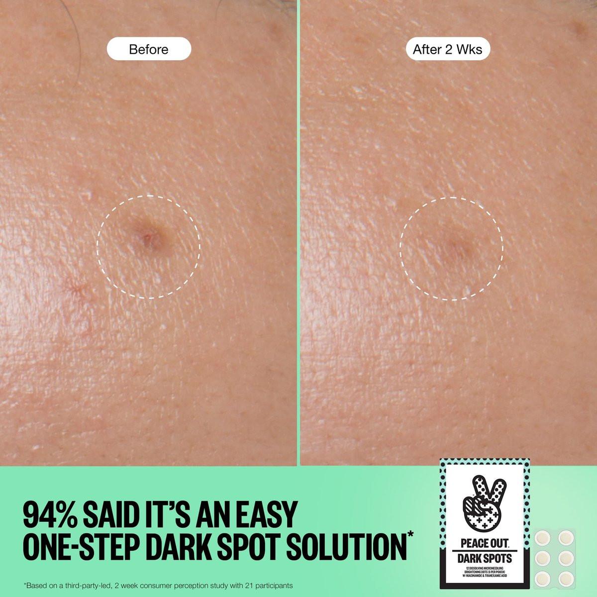 PEACE OUT Microneedling Dots für das Gesicht – Gezielte Spot-Patches mit auflösenden Mikronadeln, Niacinamid, Hydrokolloid zur Verbesserung von unebenem Hautton und -textur (12 Stück)