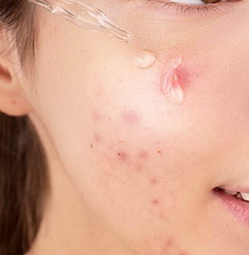 Korean Skin Care Serum mit Vitamin B & C – Niacinamid 10% + Zink 1% – Feuchtigkeitsspendendes Gesichtsserum für strahlende Haut – 30 ml (1 fl.oz.)