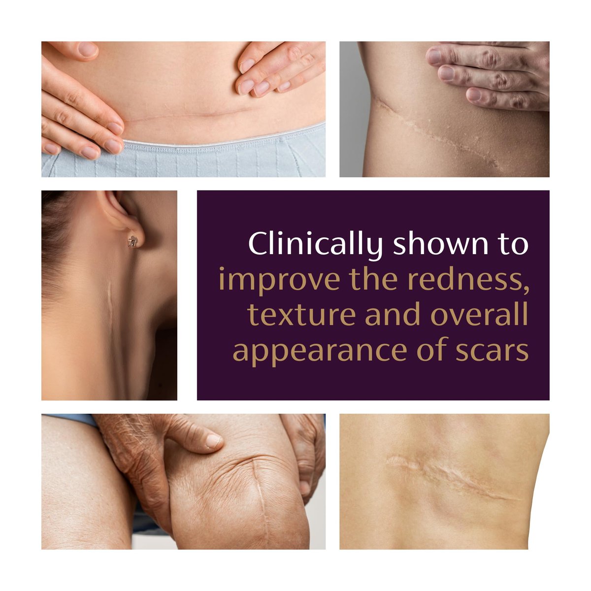 Mederma Advanced Scar Gel – Reduziert das Erscheinungsbild von alten und neuen Narben, Aknenarben, Operationsnarben, Verbrennungen, Verletzungen und Dehnungsstreifen, 20 g