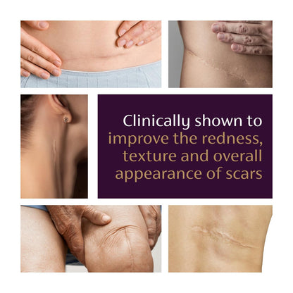 Mederma Advanced Scar Gel – Reduziert das Erscheinungsbild von alten und neuen Narben, Aknenarben, Operationsnarben, Verbrennungen, Verletzungen und Dehnungsstreifen, 20 g