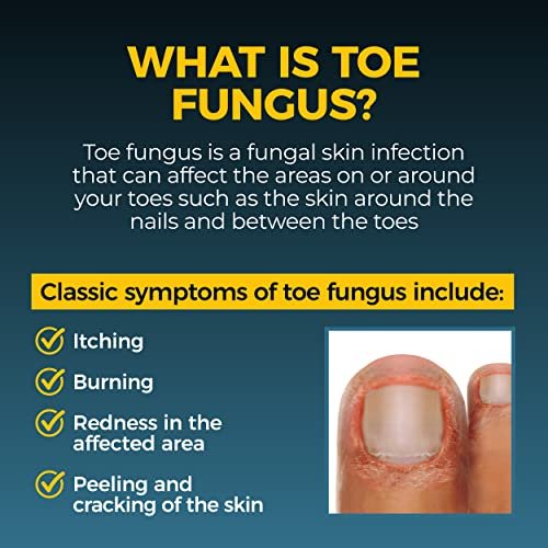 Fungi-Nail Stift-Applikator Anti-Pilz-Lösung – Tötet Pilze, die zu Nagel- und Fußpilz führen können, mit Tolnaftat & klinisch erwiesen zur Heilung und Vorbeugung von Pilzinfektionen | 0,20 Fl Oz (Packung mit 2)