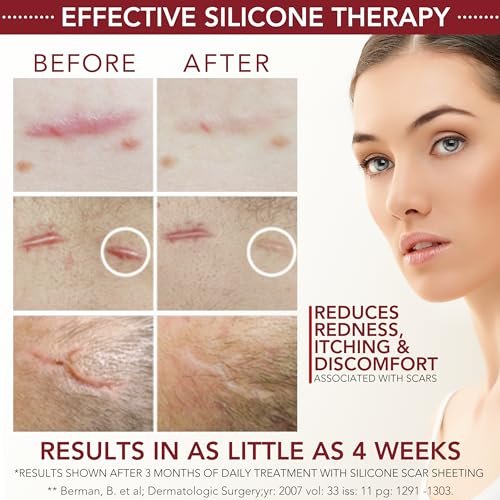 HealFast Silikon-Gel & Creme für Narben – Medizinisches Silikongel zur Narbenbehandlung bei Keloide, Akne, Verbrennungen, Kaiserschnitt, Dehnungsstreifen – Ärztlich formuliertes fortschrittliches Silikongel