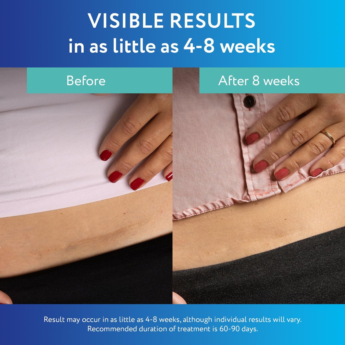 ScarAway Advanced Clear Silicone Scar Sheets - Medizinische Silikonpflaster (1,5" x 3") zur Narbenbehandlung und -prävention für chirurgische, Verbrennungs-, Körper-, hypertrophe und Keloidnarben, 10 klare Blätter