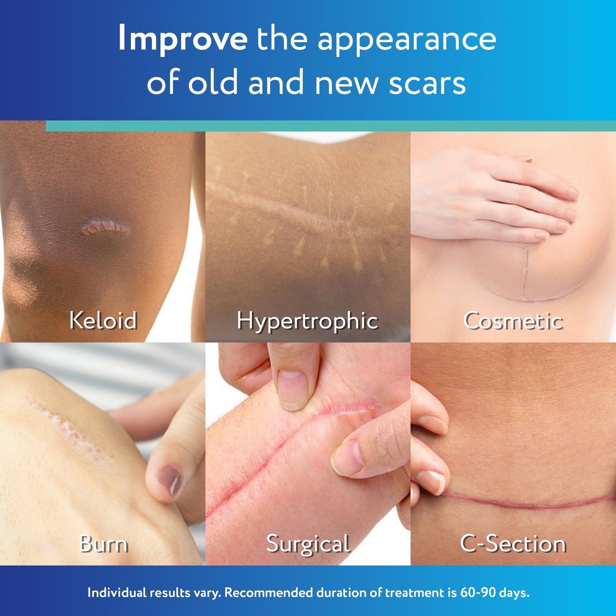 ScarAway Advanced Clear Silicone Scar Sheets - Medizinische Silikonpflaster (1,5" x 3") zur Narbenbehandlung und -prävention für chirurgische, Verbrennungs-, Körper-, hypertrophe und Keloidnarben, 10 klare Blätter
