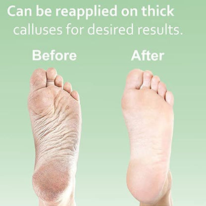 Dr. Entre's Hornhautentferner-Gel-Set für die Füße: Fußfeile, Bimsstein, 5 Paar Handschuhe für Gelauftrag, Spa-Kit, Fußpflege, Pediküre-Werkzeuge, Schrubber, 237 ml