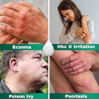 Barmicil Plus Maximum Stärke 1% Hydrocortison Creme – Intensive Anti-Juckreiz & Linderung bei Ekzemen, Psoriasis, Hautausschlag, Insektenstichen, Giftefeu – Parabenfreie Formel mit beruhigender Aloe Vera – 28 g Tube