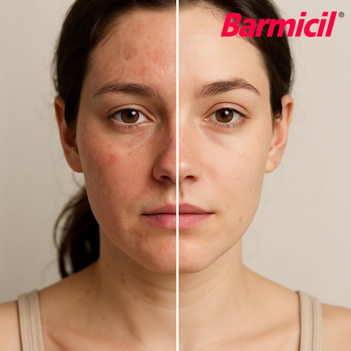 Barmicil Plus Maximum Stärke 1% Hydrocortison Creme – Intensive Anti-Juckreiz & Linderung bei Ekzemen, Psoriasis, Hautausschlag, Insektenstichen, Giftefeu – Parabenfreie Formel mit beruhigender Aloe Vera – 28 g Tube