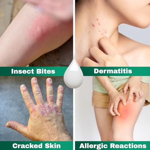 Barmicil Plus Maximum Stärke 1% Hydrocortison Creme – Intensive Anti-Juckreiz & Linderung bei Ekzemen, Psoriasis, Hautausschlag, Insektenstichen, Giftefeu – Parabenfreie Formel mit beruhigender Aloe Vera – 28 g Tube