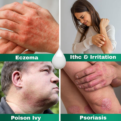 Barmicil Plus Maximum Stärke 1% Hydrocortison Creme – Intensive Anti-Juckreiz & Linderung bei Ekzemen, Psoriasis, Hautausschlag, Insektenstichen, Giftefeu – Parabenfreie Formel mit beruhigender Aloe Vera – 28 g Tube