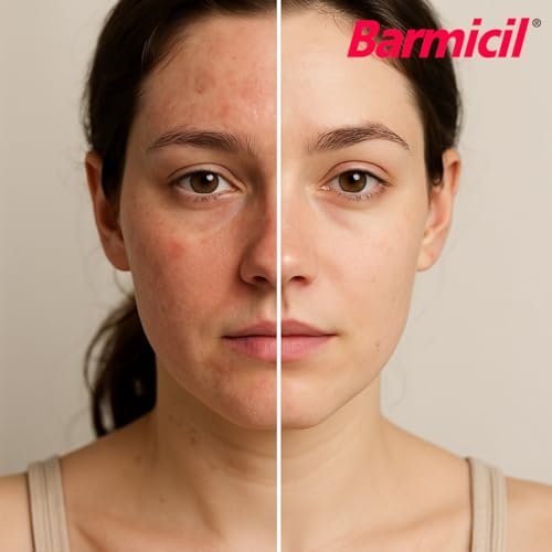 Barmicil Plus Maximum Stärke 1% Hydrocortison Creme – Intensive Anti-Juckreiz & Linderung bei Ekzemen, Psoriasis, Hautausschlag, Insektenstichen, Giftefeu – Parabenfreie Formel mit beruhigender Aloe Vera – 28 g Tube