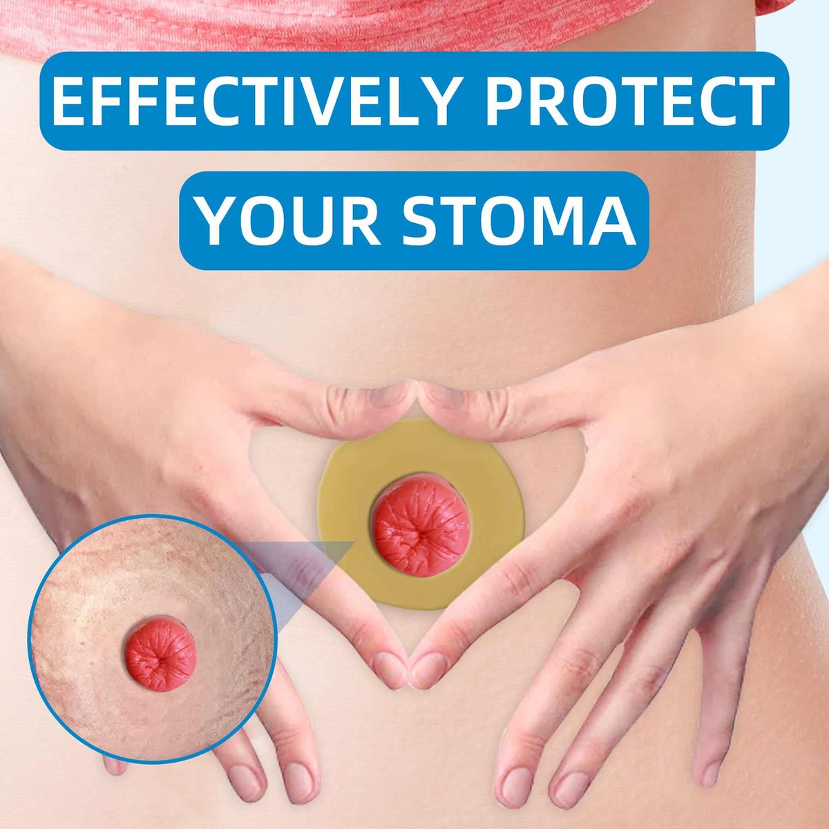 10 Stück Ostomy-Barriereringe, stichfrei, formbar, Hydrokolloid-Hautverlängerungsringe für Kolostomiebeutel
