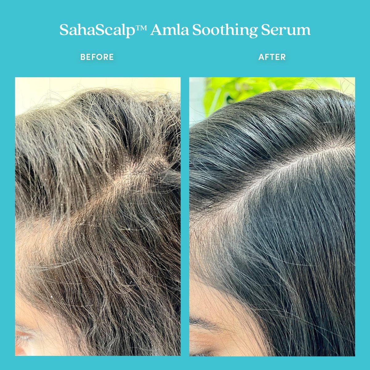 Fable & Mane Amla Soothing Serum mit Rosmarinöl – Beruhigende Kopfhautpflege für trockene, juckende & empfindliche Kopfhaut