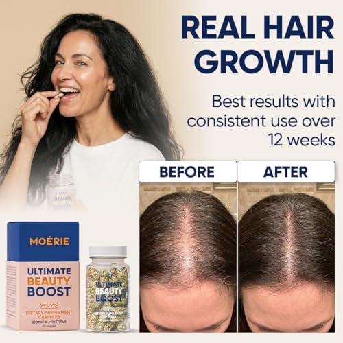Moerie Ultimate Haarwachstumsergänzung für Frauen & Männer - Haare, Haut, Nägel Vitamine mit Biotin & Mineralien - für dichteres, volleres Haar & Haarausfall Behandlung - 360 Kapseln