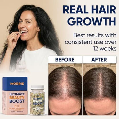 Moerie Ultimate Haarwachstumsergänzung für Frauen & Männer - Haare, Haut, Nägel Vitamine mit Biotin & Mineralien - für dichteres, volleres Haar & Haarausfall Behandlung - 360 Kapseln