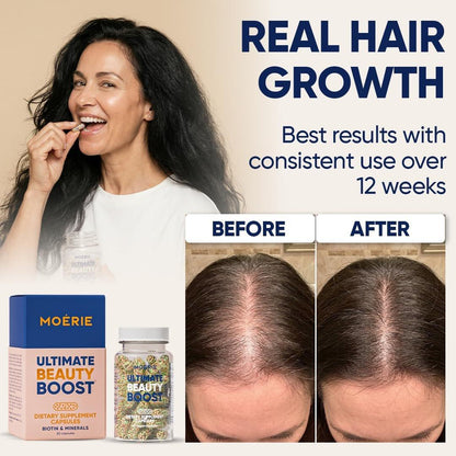 Moerie Ultimate Haarwachstumsergänzung für Frauen & Männer - Haare, Haut, Nägel Vitamine mit Biotin & Mineralien - für dichteres, volleres Haar & Haarausfall Behandlung - 360 Kapseln