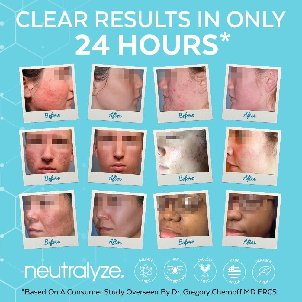 Neutralyze Akne-Behandlungsset 2.0 für mittelschwere bis schwere Akne – maximal starkes 3-Stufen-Akne-Set mit 2% Salicylsäure, 2% Mandelsäure & Stickstoffmonoxid – inklusive Gesichtsreinigung, Klärungsserum & Synergyzer